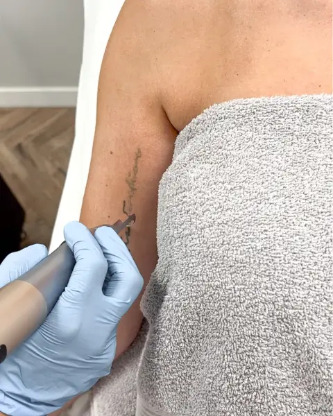 Tattoo Verwijderen