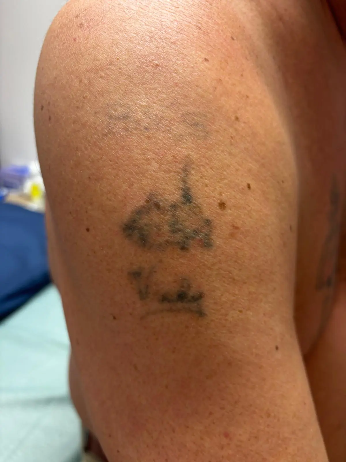 Hond tattoo, schouder — na 1 PICO-laser sessie